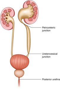 obstruction puj junction ureteric pelvic pelvi